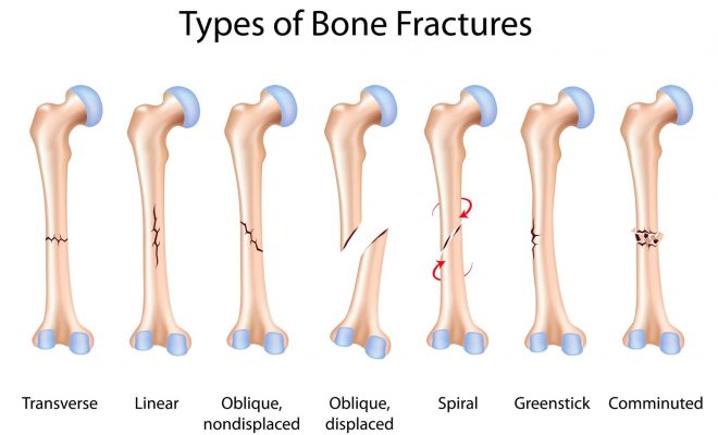 Treatment of Broken Bones